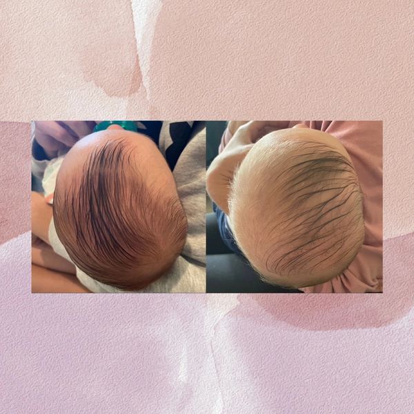 before and after photos of a baby with plagiocephaly.