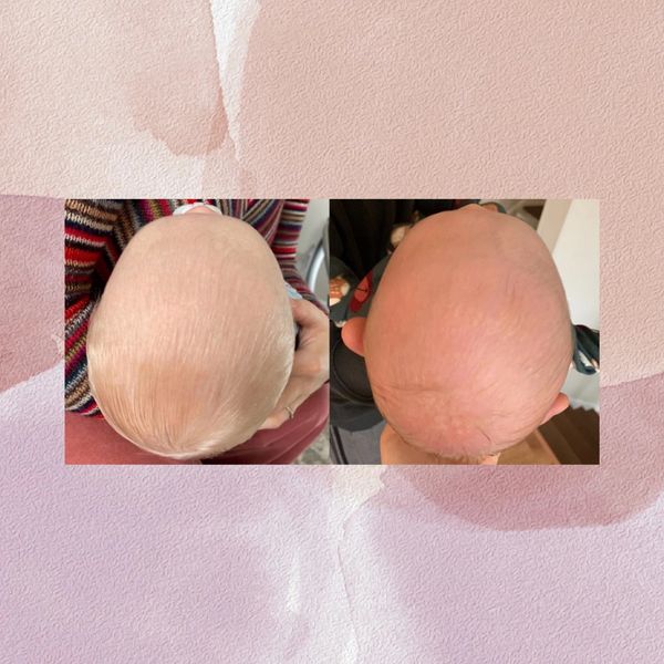 before and after photos of a baby with plagiocephaly.