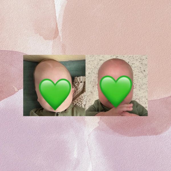 before and after photos of a baby with plagiocephaly and head height unleveling