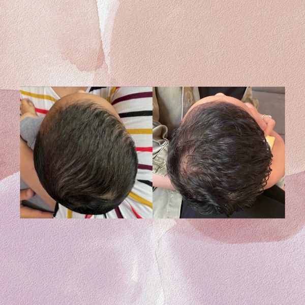 before and after photos of a baby with plagiocephaly.