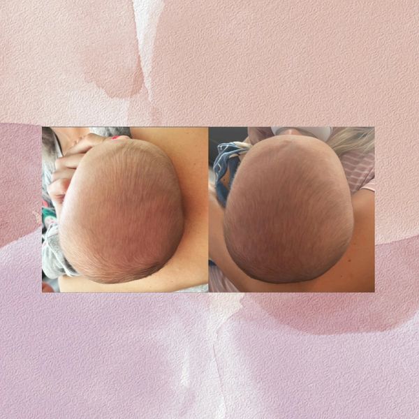 before and after photos of a baby with plagiocephaly.