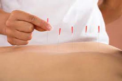 Dry needles may help relieve muscle pain and spasm and help improve movement 