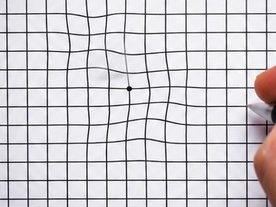 Amsler grid showing central distortion