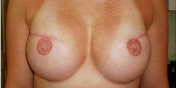 Tattooed nipple areola coloration