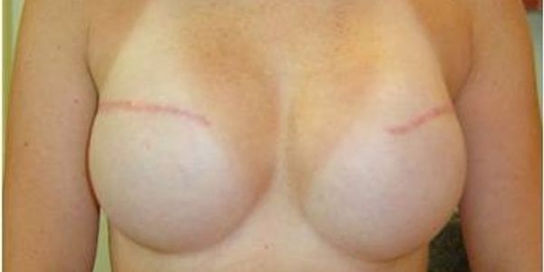 No nipple areola after breast reconstruction