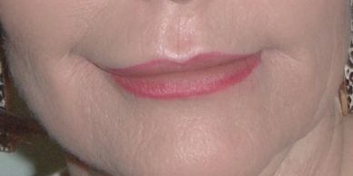 MCA removes wrinkles around the lips