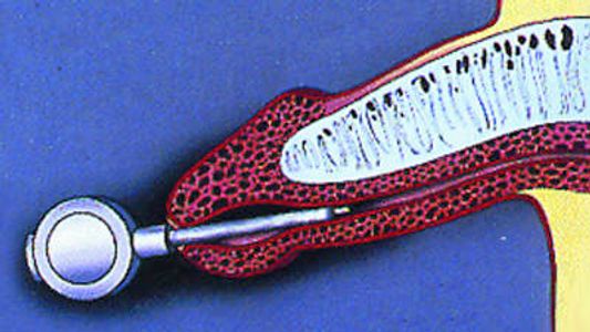 A penis muse or suppository is inserted to urethra for erection for those suffering from impotence