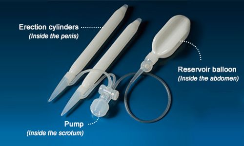 Penile implant like semi rigid,two or three piece treatment for erectile dysfunction and impotence.