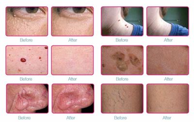 Skin Sheek treats skin imperfections