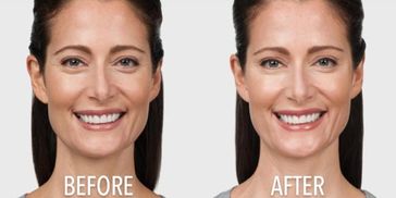 Before and after results of Botox.