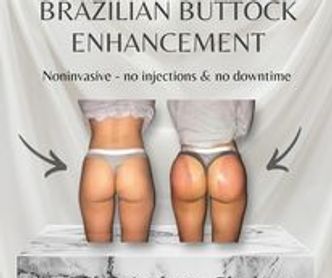 This is before and after results of our Brazilian buttock enhancement