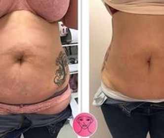 This is before and after a laser lipo and fat cavitation course