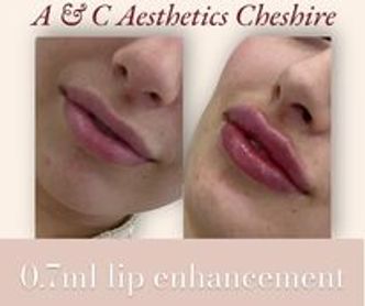 This is before and after lip enhancement