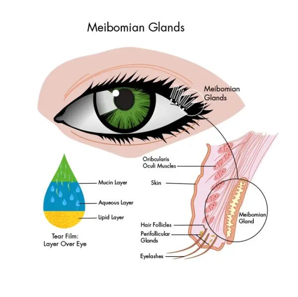 Meibomian Gland Dysfunction