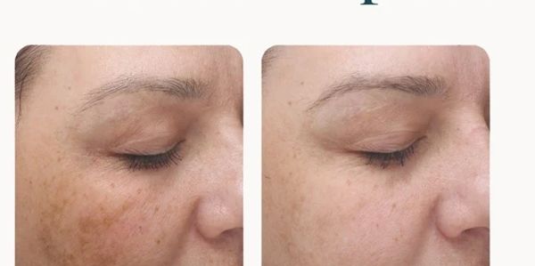 Before and after skin improvement showing reduced pigmentation.