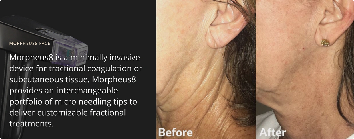 Before and after photos of Mopheus8 neck treatment and facts about Morpheus face