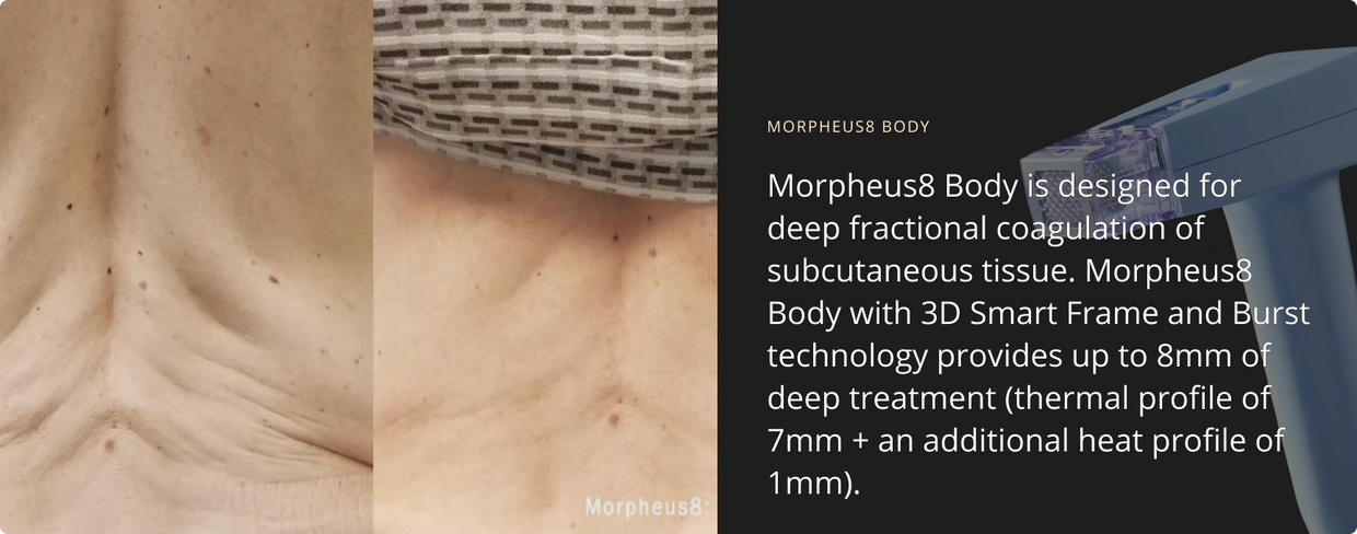 Before and after photos of Morpheus back treatment and Morpheus body facts.