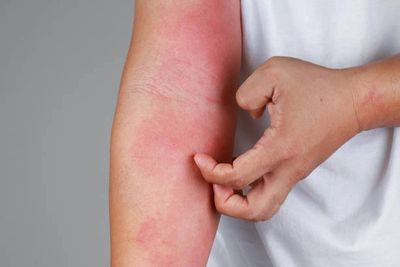 Person scratching red, irritated skin on their arm.