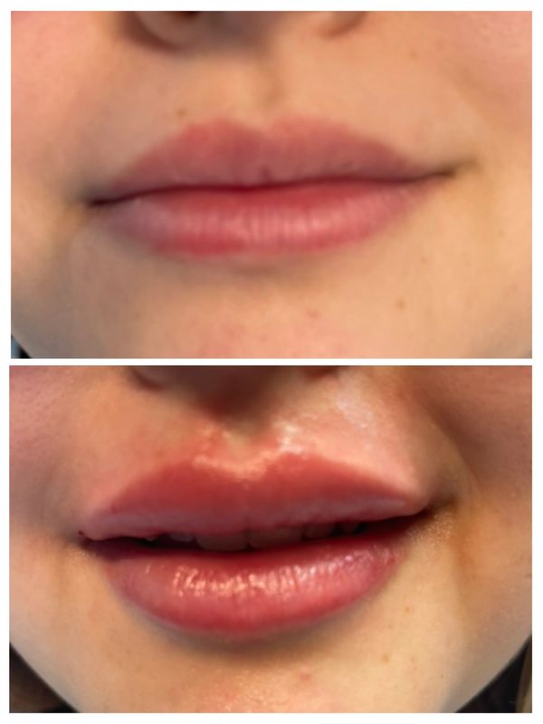 Lip filler