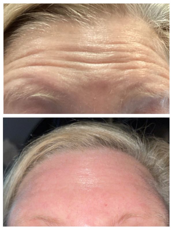 Before and after images showing reduced forehead wrinkles.