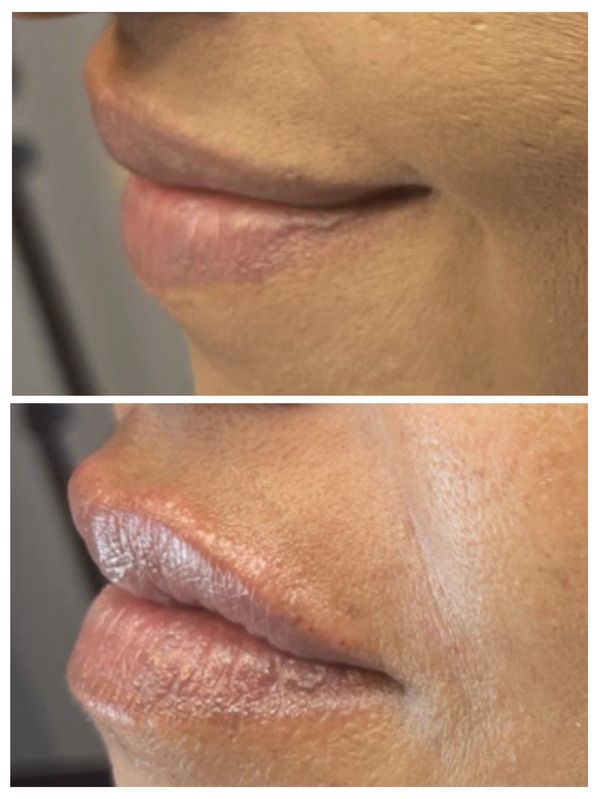 Dermal filler to enhance lip volume