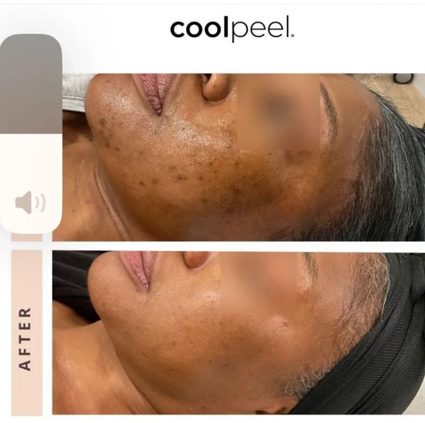 Before and after photos showing improved skin clarity and reduced hyperpigmentation.