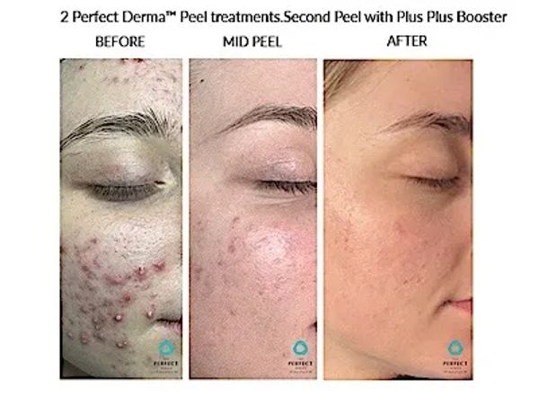 Three-stage facial skin transformation from acne to clear skin after peel treatments.