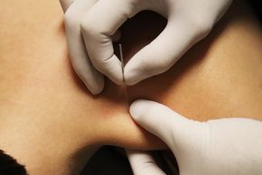 Trigger Point Dry Needling. Myofascial Release. Neck Referral Pain. Upper Trapezius dry needling.