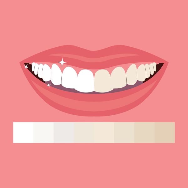 Half teeth whitening illustration with shade guide.