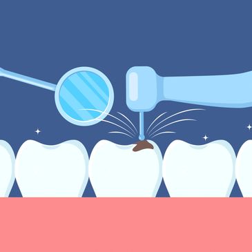 Dental tools cleaning a cavity in a tooth.