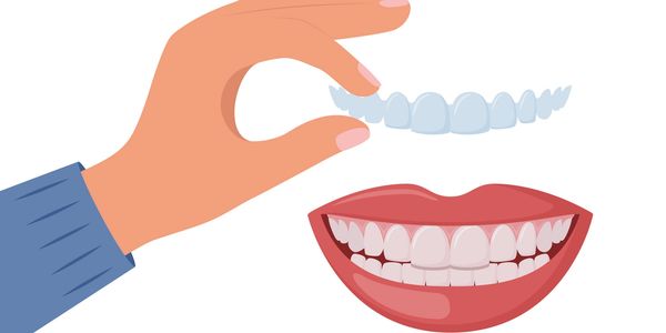 Hand holding clear dental aligner above smiling mouth.