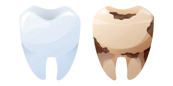 Healthy tooth next to a decayed tooth.