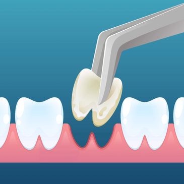 Illustration of tooth extraction using forceps.