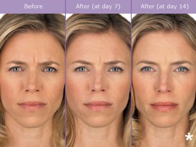 Botox Dysport Wrinkles Aging Antiaging