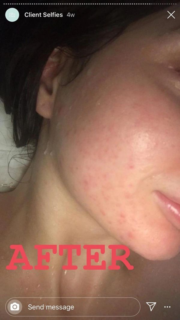 customer review after using the face exfoliating mitt, with reduced pimples and acne