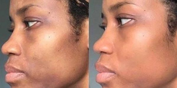 rejuvenate, dead skin removal, acne, open pores, fine lines, wrinkles, microdermabrasion