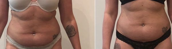 Weight loss, fat reduction, endermologie, fat freezing, fat burning, lose weight, skin tightening,