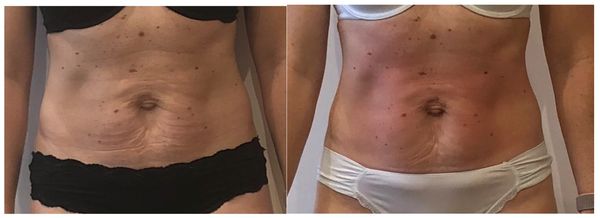 Weight loss, fat reduction, endermologie, fat freezing, fat burning, lose weight, skin tightening,