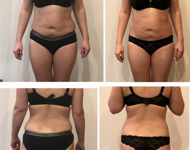 Weight loss, fat reduction, endermologie, fat freezing, fat burning, lose weight, skin tightening,