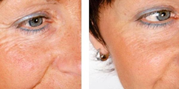 microdermabrasion microneedeling dermarolling, fine lines, crows feet