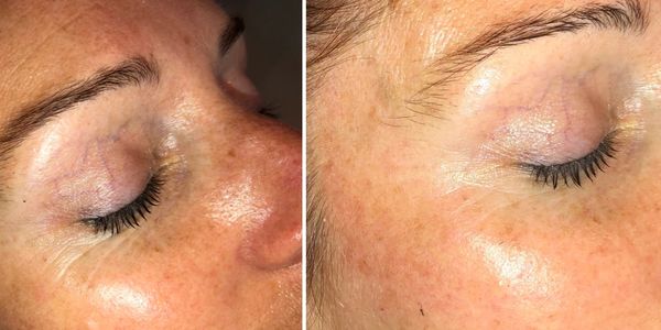 Eliminates dark circles & wrinkles                                    (After 4 x 30minute