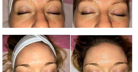 fine lines, wrinkles, dark circles, puffy eyes