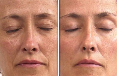 Endermologie, non surgical face lift. The face is redrawn with clearer contours