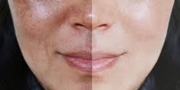 chemical peel age spots acne scarring  fine lines