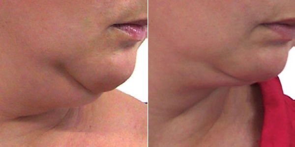 double chin, fat around the face