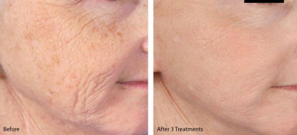 age spots, acne scaring, fine lines, wrinkles, sagging skin
