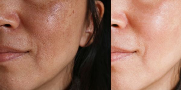 chemical peels age spots acne scarring