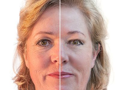 skin tightening wrinkles dark circles puffy eyes