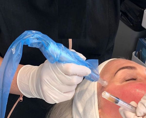 microneedling, gine lines, age spots, acne scaring, rejuvenate dead skin