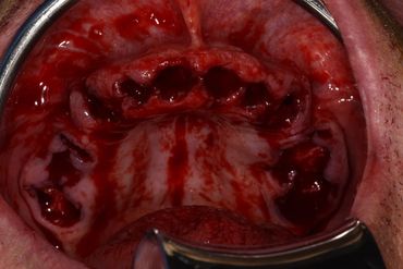 Serial extractions